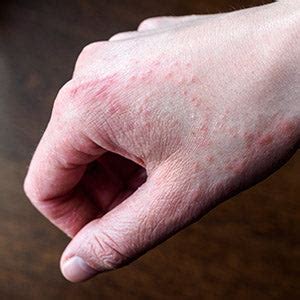 Hand Dermatitis - Learn about hand dermatitis and sensitive skin – exederm