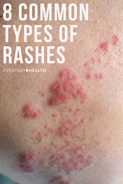 Types Of Skin Rashes In Children