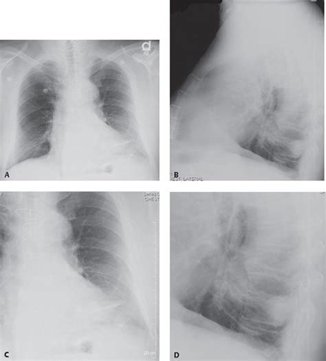 48 Rounded Atelectasis | Radiology Key