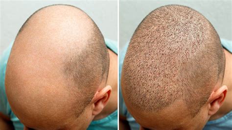 Hair Transplant: Reversing The Effects Of Balding - Petercatrecordingco