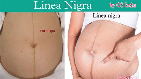 Linea Nigra, What linea nigra? in during pregnancy — GS India Nursing ...