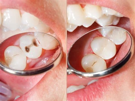 Dental Fillings - Northern Sky Dental