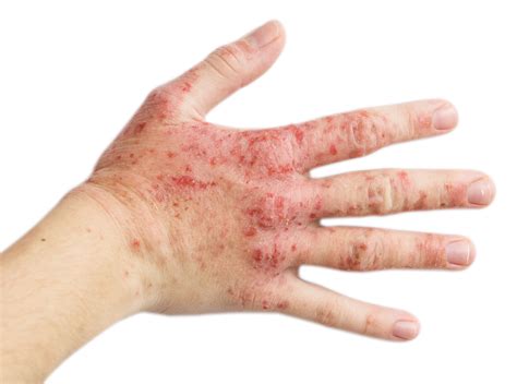 Abrocitinib for Atopic Dermatitis