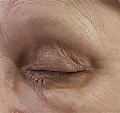 Xanthelasma Removal Treatment – Changes Clinic