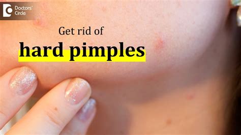 How to get rid of hard pimples? - Dr. Urmila Nischal - YouTube