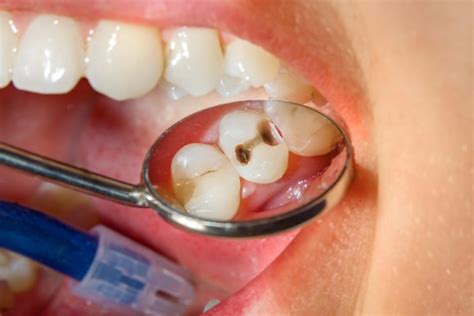 Cavity Treatment: How to Treat the 3 Most Common Types of Cavities ...