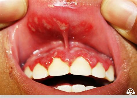 Herpetic Gingivostomatitis