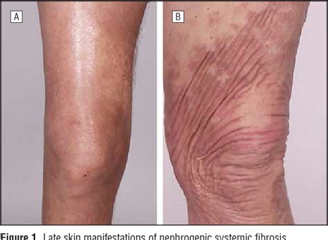 [PDF] Nephrogenic systemic fibrosis: late skin manifestations. | Semantic Scholar