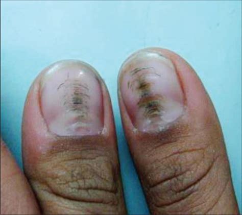 Dystrophic Nails Meaning - Nail Ftempo