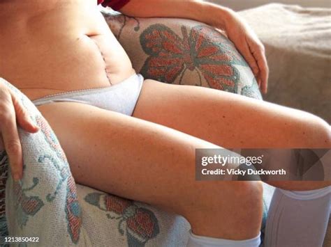 15 Hysterectomy Scar Stock Photos, High-Res Pictures, and Images - Getty Images