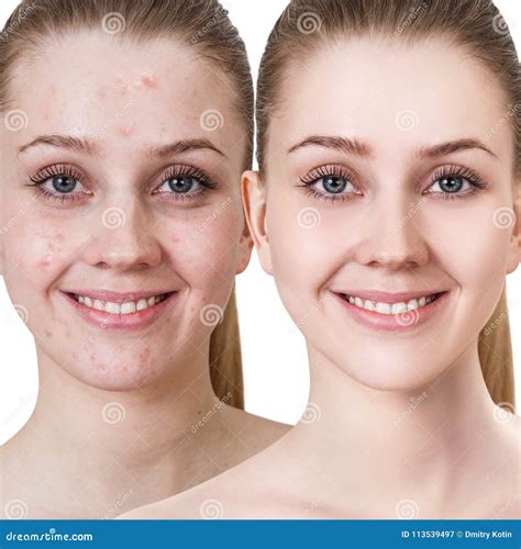 Young Woman with Acne before and after Treatment. Stock Image - Image ...