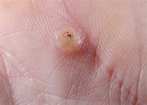 Do Warts Have Seeds? | Help My Skin Today