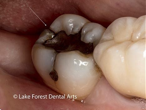 Procedure For Cracked Molar