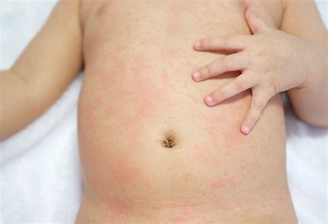 Heat Rash On Baby Causes And Treatment Bellybelly - Riset