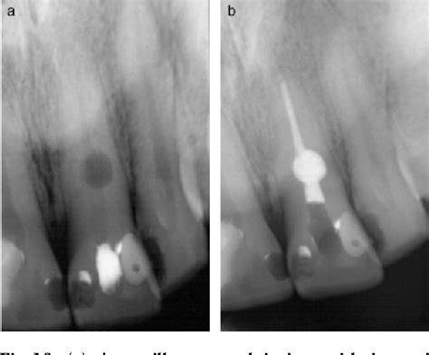 Figure 18 from Internal inflammatory root resorption: the unknown resorption of the tooth ...