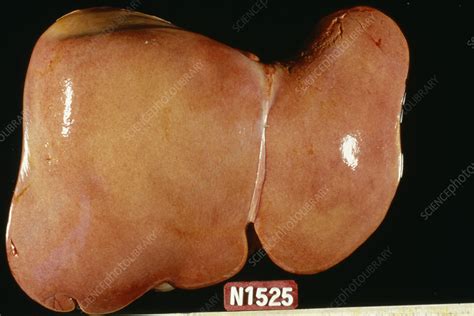 Liver steatosis - Stock Image - M260/0252 - Science Photo Library