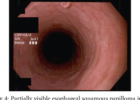 [PDF] Squamous Cell Papilloma of the Esophagus: A Case Series Highlighting Endoscopic and ...