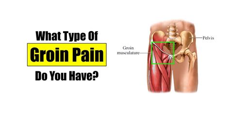 What Kind of Groin Pain Do You Have? – Squat University