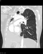 Pneumonectomy | Radiology Reference Article | Radiopaedia.org