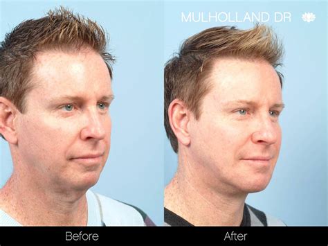 Double Chin Surgery For Men | Toronto Plastic Surgeons