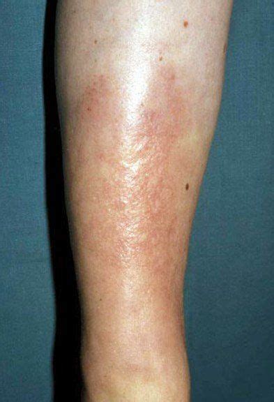 Pretibial myxedema pictures treatment symptoms causes – Artofit