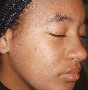 Acne Medication - Aczone Acne Gel Medication- Online Prescriptions