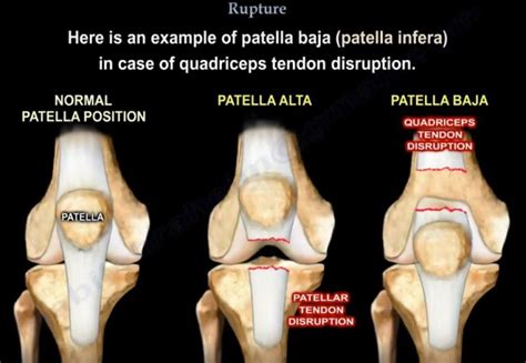 Quadriceps Tendon Rupture — OrthopaedicPrinciples.com