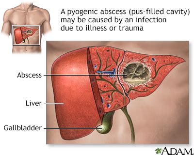 Pyogenic Liver Abscess Symptoms, Doctors, Treatments, Advances & More | MediFind