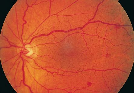 Ocular Ischemic Syndrome | Ento Key