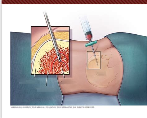 hematology pics-Bone marrow aspiration Diagram | Quizlet