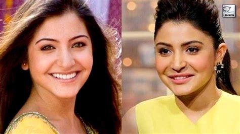 Anushka Sharma Nose Job