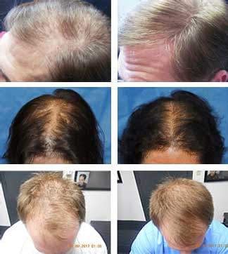 Laser Hair Loss Treatment for Hair Loss | Cleveland Columbus Ashland OH