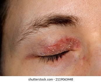 Best Eczema Eye Royalty-Free Images, Stock Photos & Pictures | Shutterstock