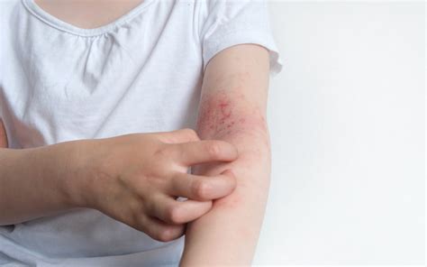 Managing the itch: all you need to know about childhood eczema | FMT