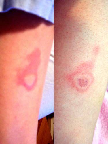 Black Widow Spider Bite Treatment Ems ~ Black Widow Spider Bite Pictures | Enterisise