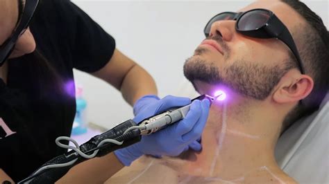 LASER HAIR REMOVAL FOR MEN | ALEX COSTA - YouTube