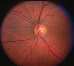 Optic Nerve Atrophy - American Association for Pediatric Ophthalmology and Strabismus