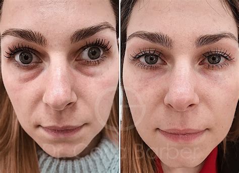 Quita las ojeras de forma natural y eficaz con cucharas: ¡Descubre el ...