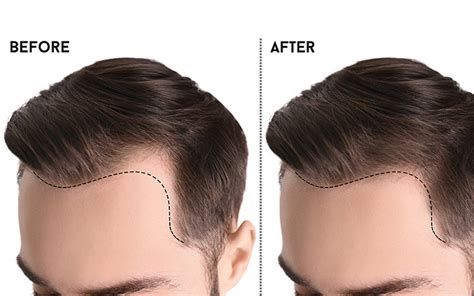 Understanding The Different Types Of Hairlines For Men And Women – SkinKraft