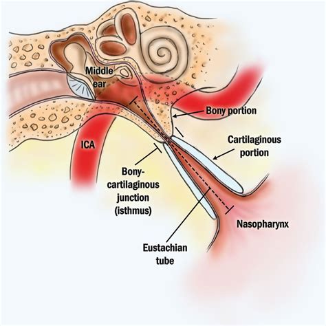 Eustachian Tube Dysfunction - Easmed