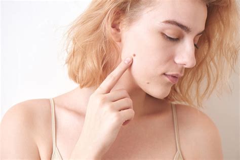 Why Do You Get Skin Moles and Beauty Marks? - Metrin Skincare