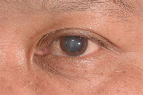 Cataracts - Symptoms, Causes & Treatment | Lions Eye Institute