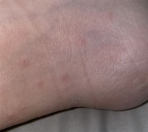 Sand Flea Bites Vs Bed Bug Bites