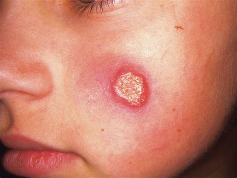 Cutaneous Leishmaniasis