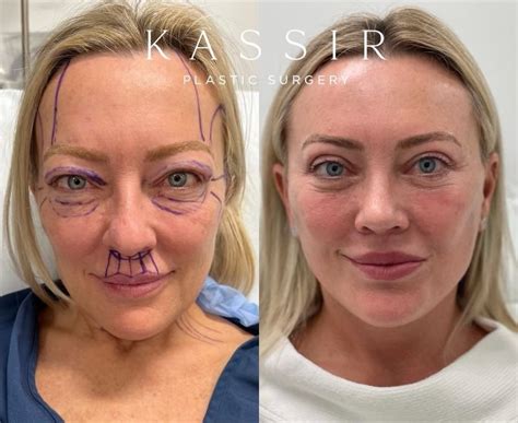 Does a deep plane facelift last longer, and why you should see an ...