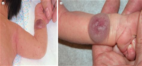 Congenital Hemangiomas: Rapidly Involuting and Noninvoluting Congenital Hemangiomas | Congenital ...