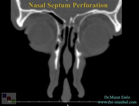 Health Zone Turkey: Symptoms, Causes and Diagnosis of Nasal Septum ...