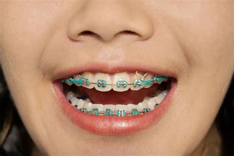 Elastics for Braces – Everything You Need to Know - Dr. Whitlock