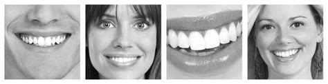 Invisalign Before and After Pictures