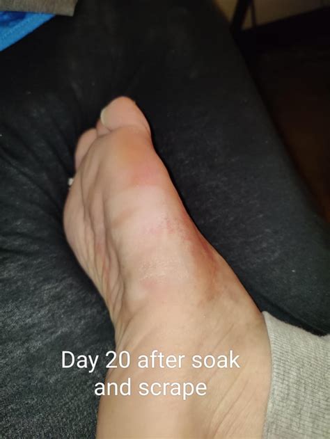 Plantar wart duct tape progress. : r/Warts